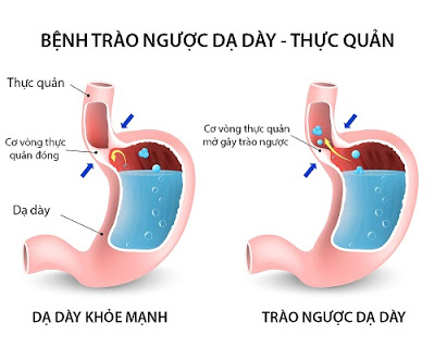 Cách điều trị bệnh trào ngược dạ dày thực quản