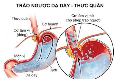 Cách điều trị bệnh trào ngược dạ dày thực quản