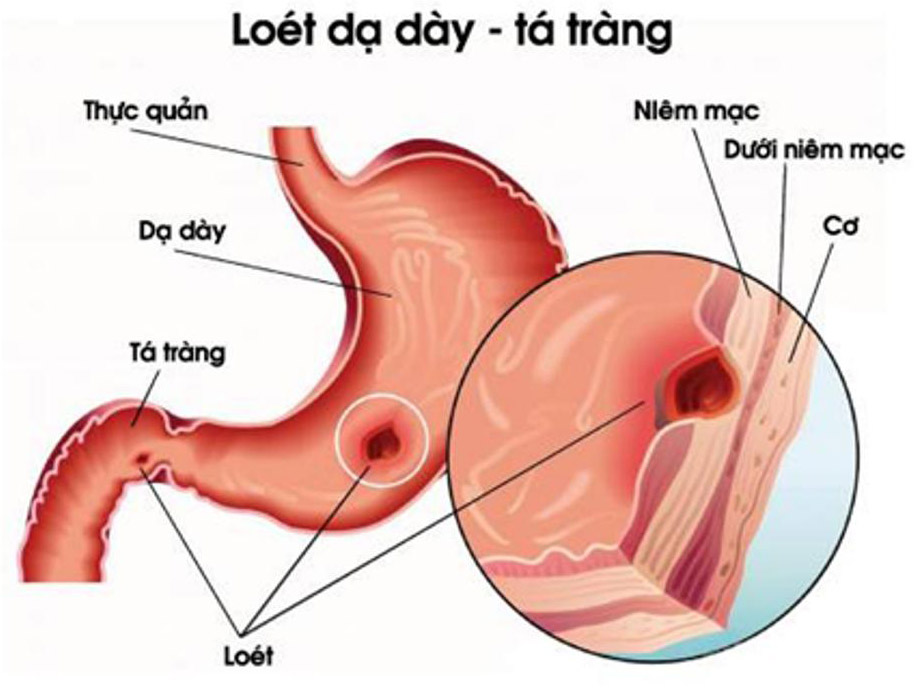 khong-chu-quan-voi-benh-trao-nguoc-dich-mat-2