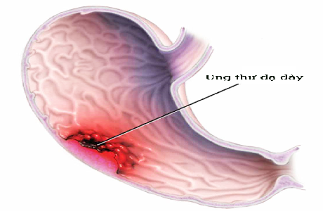 khong-chu-quan-voi-benh-trao-nguoc-dich-mat-4