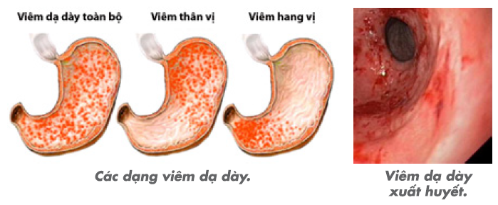 benh-viem-niem-mac-da-day-co-nguy-hiem-khong-3