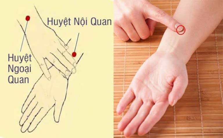 Bấm huyệt nội quan tốt cho người bệnh viêm loét dạ dày tá tràng