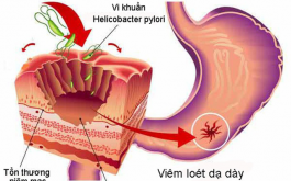 cơ chế điều trị bệnh viêm loét dạ dày Hp