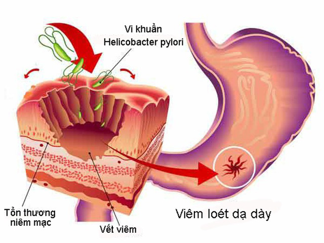 Cơ chế điều trị bệnh viêm loét dạ dày Hp