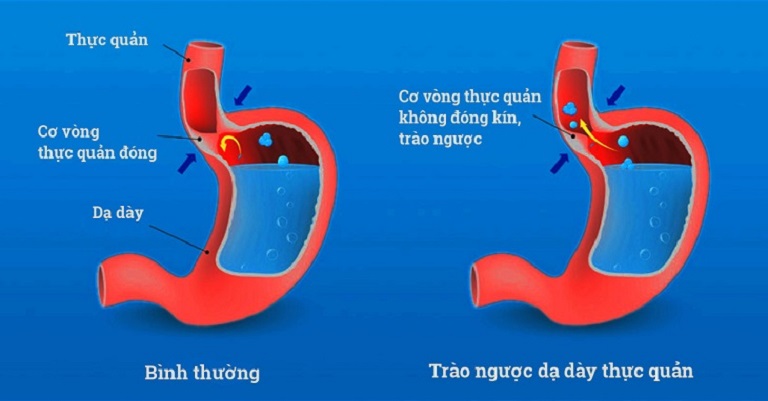 Trào ngược dạ dày xảy ra do sự mất cân bằng dịch vị