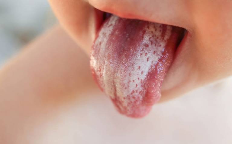 Trẻ bị trào ngược dạ dày xuất hiện tưa lưỡi