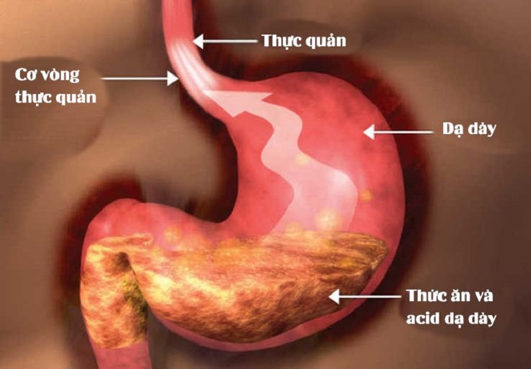  Trào ngược dạ dày tên khoa học là Gastroesophageal Reflux Disease (GERD)