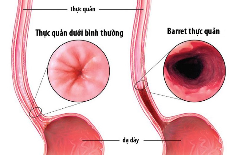 Barett thực quản là biến chứng nguy hiểm của trào ngược dạ dày