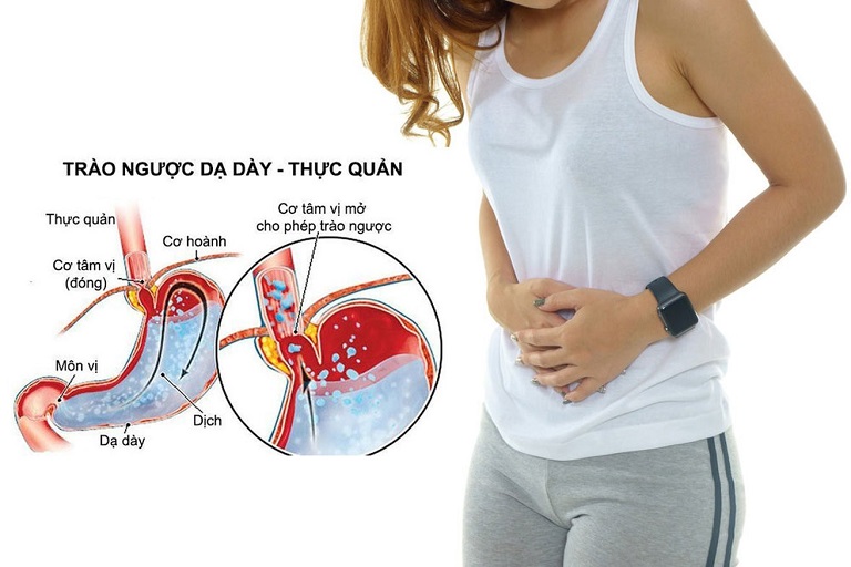 Nguyên lý hoạt động của trào ngược dạ dày thực quản cấp A