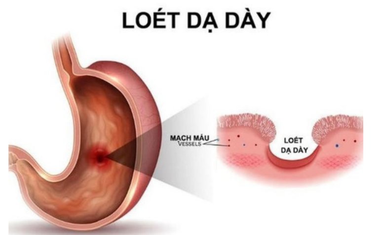 Biến chứng loét dạ dày tá tràng do nhiễm vi khuẩn Hp