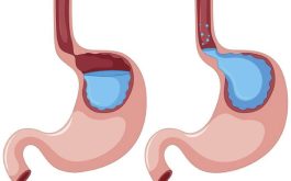 Trào ngược dạ dày có xử lý được không? Cách khắc phục tối ưu hiện nay