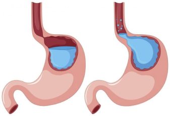 Trào ngược dạ dày có xử lý được không? Cách khắc phục tối ưu hiện nay