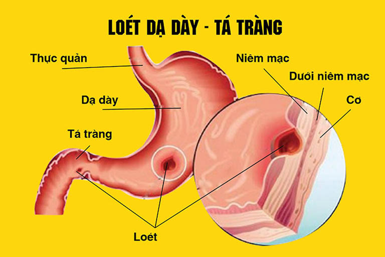 Nếu không được khắc phục kịp thời bệnh có thể gây viêm loét dạ dày - tá tràng