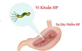 Viêm dạ dày HP là gì? Nguyên nhân, triệu chứng và cách khắc phục