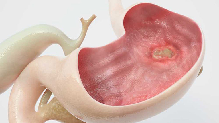 Viêm dạ dày HP có nguy hiểm không? - Bệnh có thể gây viêm loét dạ dày Viêm dạ dày HP có nguy hiểm không? - Bệnh có thể gây viêm loét dạ dày