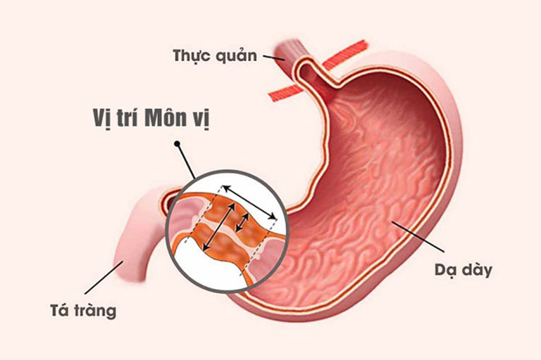 Viêm hang vị kéo dài có thể gây tắc môn vị - vị trí nối liền giữa dạ dày và phần đầu ruột non