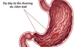 Viêm Loét Dạ Dày Có Nguy Hiểm Không? Làm Sao Để Khắc Phục?